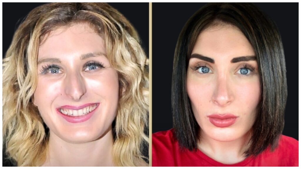 Laura Loomer before and after plastic surgery celebretea.com